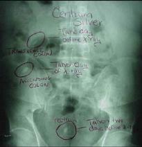 X-Ray of Name Brand Pills Stuck in the GI Tract