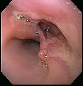 Capsules & Pills Stuck in the Intestine