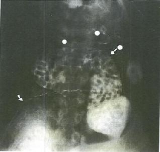 100's of Fragmented Pills & Capsules stuck in the GI Tract