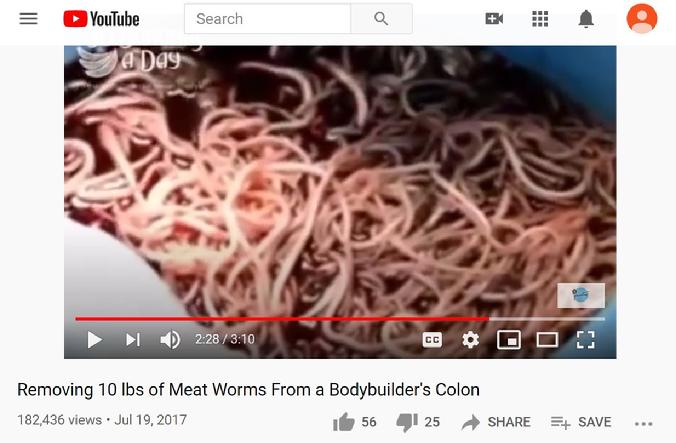 Surgically Removed Worms From Human Bodybuilder Colon