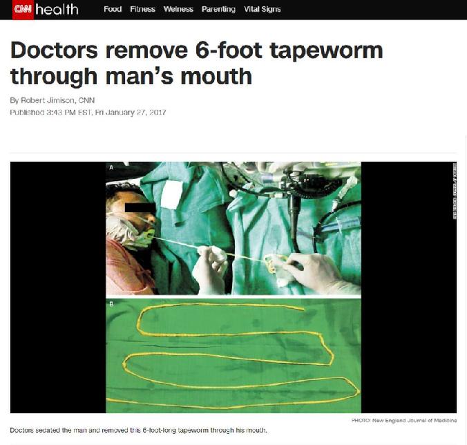 6 Foot Tape Worm Removed Oral Surgery