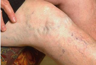 Varicose Veins